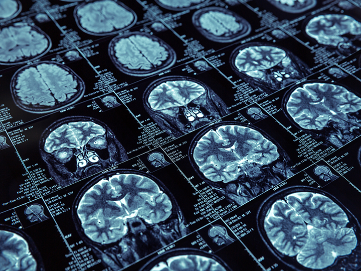 Brain GettyImages Brain GettyImages