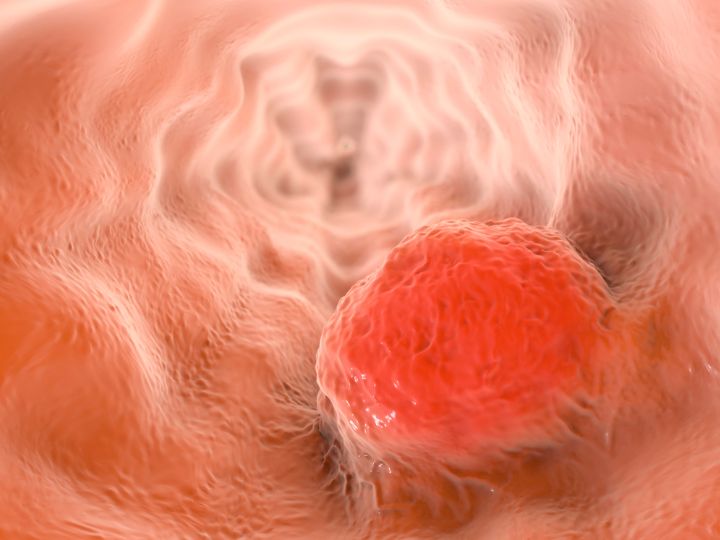 Esophageal cancer tumor Esophageal cancer tumor