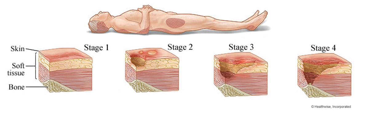 Stages of bedsores